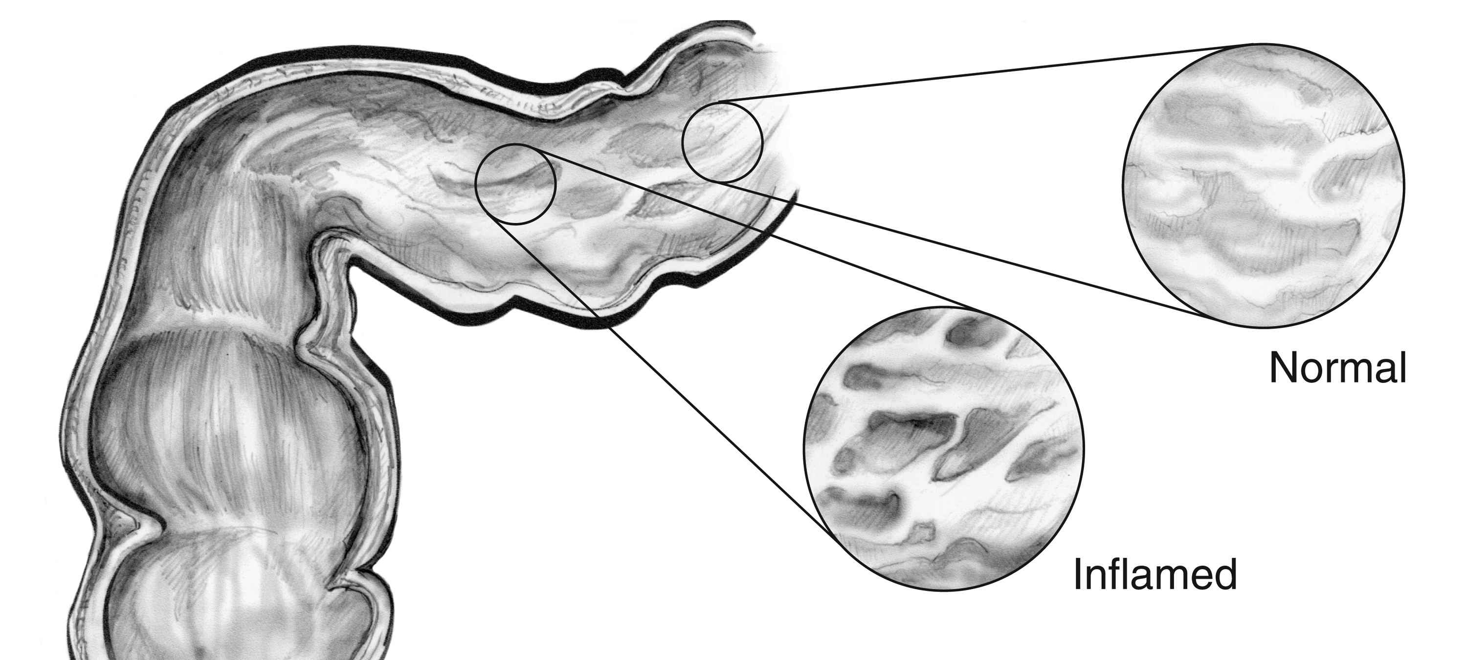 Illustration comparing normal intestinal lining with inflammation and scarring seen in Crohn's disease